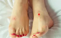 8 dấu hiệu ở chân cảnh báo bạn có thể đang mắc bệnh nguy hiểm