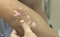 Điều trị bệnh bạch biến bằng phương pháp nào?