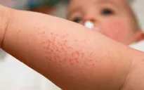Mỹ ghi nhận hơn 1.000 ca nhiễm sởi