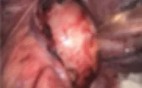 Phẫu thuật lấy khối u trung thất nằm ở vị trí "hiểm"