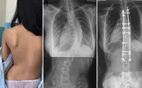 Chuyên gia nước ngoài khám, tư vấn miễn phí bệnh lý cột sống tại Hà Nội