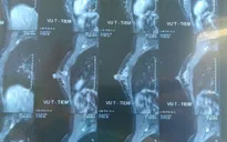Cảnh báo tình trạng trẻ hóa ung thư vú