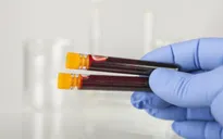 Xét nghiệm máu có thể dự đoán nguy cơ tái phát sau chẩn đoán mắc bệnh ung thư vú