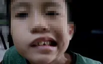 Ngủ dậy, bé trai bỗng dưng bị méo miệng, liệt mặt