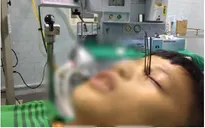 3 cây đinh kim loại từ súng tự chế ghim vào hốc mắt bé trai 13 tuổi
