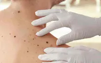Tỷ lệ ung thư da ở Anh tăng 45%