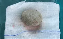Lấy viên sỏi hơn 3cm trong bàng quang bé trai 13 tuổi