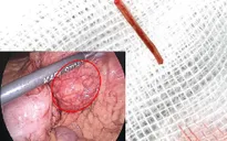 Tưởng đau bụng do rối loạn tiêu hóa, vào viện phát hiện xương cá đâm thủng ruột