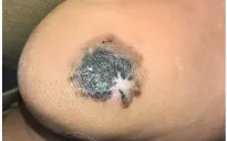 Từ một đốm đen nhỏ ở gan bàn chân, người đàn ông vào viện phát hiện ung thư da