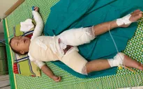 Bé trai hơn 3 tuổi người Mông bị bỏng nước sôi nguy kịch cần giúp đỡ