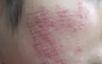 Tai biến do lăn kim, tiêm vi điểm