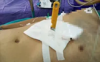 Vào viện với con dao gọt hoa quả đang... cắm sâu ở bụng