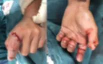 Nối ngón tay bị đứt lìa do cưa máy cắt cho thanh niên 18 tuổi