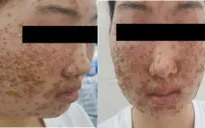 Khuôn mặt phủ kín vảy sau khi dùng sữa rửa mặt mua qua mạng