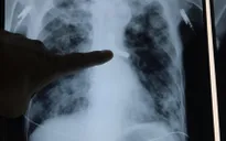 Cả hàm răng giả rơi vào... phế quản cụ ông 89 tuổi