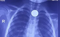 Bé trai 3 tuổi phải vào viện vì đồng xu mắc kẹt ở thực quản