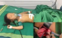 Hãi hùng: Bé gái 4 tuổi bị máy cắt lòi ruột, gia đình tự... lấy kim chỉ khâu lại