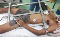 Rơi từ trên cây, bé trai 13 tuổi bị hàng rào sắt đâm vào ngực