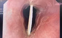 Đi ăn cỗ về, cụ bà 72 tuổi phải vào viện vì hóc xương