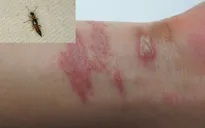 Cảnh báo viêm da do tiếp xúc kiến ba khoang
