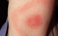 Những dấu hiệu nguy hiểm khi bị côn trùng cắn