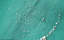 Phẫu thuật gỡ bỏ... 526 chiếc răng trong miệng cậu bé 7 tuổi