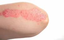 Bệnh vảy nến có lây?