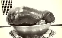 Mổ cắt khối u lách chiếm hết nửa ổ bụng trái nam thanh niên