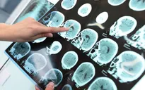 Bệnh mất trí nhớ alzheimer có sự khác biệt theo giới tính