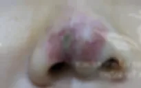 Hám rẻ, cô gái trẻ phải nhập viện sau tiêm filler