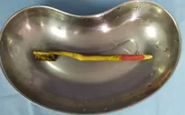 Lấy bàn chải dài 18cm trong... tá tràng bệnh nhân