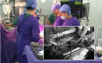 Xuyên đêm cấp cứu bệnh nhân vỡ tim do tai nạn giao thông