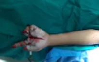 Thêm một bé trai nhập viện với nhiều vết thương do pháo nổ