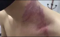 Hà Nội ghi nhận hàng nghìn trường hợp nhiễm độc kiến ba khoang phải vào viện