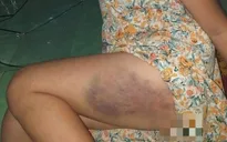 Xác minh việc học sinh lớp 3 bị cô giáo đánh bầm tím đùi