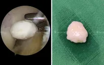Loại bỏ mảnh sạn gây kẹt khớp gối