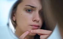 “Thất tình mọc mụn” có thật hay không?