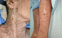 Tổn thương da lan tỏa toàn thân do nhiễm herpes