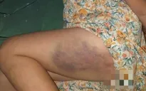 Phạt 3,75 triệu đồng, đình chỉ 3 tháng với cô giáo đánh học sinh lớp 3 bầm tím