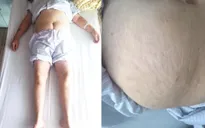 Báo động tình trạng lạm dụng corticoid