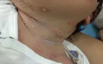 Viêm da mủ ở trẻ em