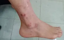 Biến chứng da do tùy tiện dùng Corticoid bôi ngoài da