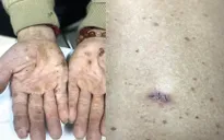 Cảnh báo ung thư da do nhiễm độc thạch tín