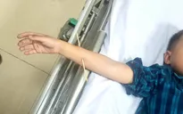 Nô đùa sau khi ăn, bé 6 tuổi bị xiên que đâm xuyên cẳng tay