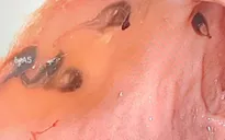 Nội soi gắp... 50 con sán lá gan trong đường mật bệnh nhân