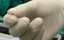 Lấy hạt cườm nằm cả tháng trong ống tai bé 2 tuổi