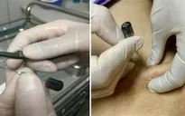 Phương pháp cấy chỉ catgut và ứng dụng điều trị bệnh