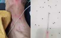 Cứu 2 bệnh nhân sốc phản vệ nguy kịch do ong đốt