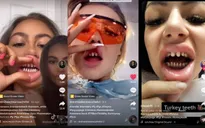 Xu hướng mài răng trên TikTok: Thẩm mỹ hay rủi ro sức khoẻ?