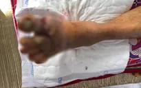 Nối bàn chân gần đứt rời do máy cắt cỏ chém vào